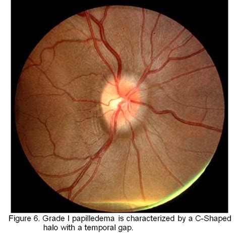 Papilledema Grades. EyeRounds.org - Ophthalmology - The University of Iowa