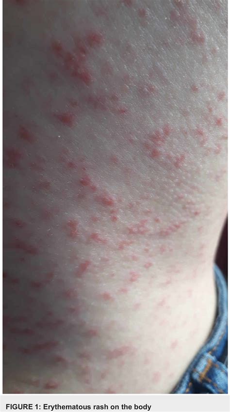 Erythematous Papular Rash