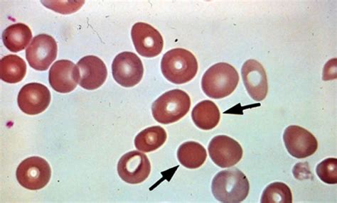 Spherocytosis and hereditary spherocytosis causes, symptoms & treatment