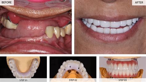 Dental Implants Results (Before & After) - 22 Cases