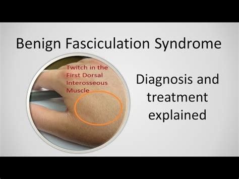 Benign Fasciculation Syndrome Causes and Treatment : u/RigidLevinsvqO