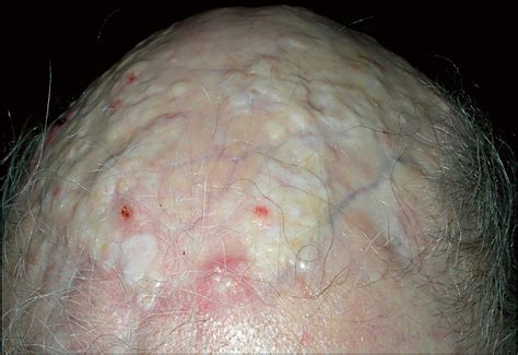 Diffuse Dystrophic Calcinosis Cutis of the Scalp in a Patient With Scalp Discoid Lupus ...