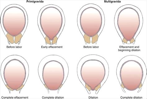 Cervix Dilation Chart Awesome Image Result For How Cervix Dilate Cervical Dilation Chart Sale ...