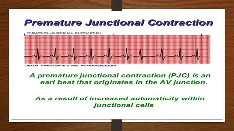 #2 Lecture on Junctional Rhythms - YouTube