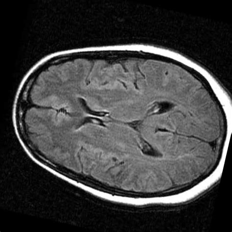 Brain Cancer Detection - MRI Images Classification Dataset (v2, 2023-01-24 5:04pm) by Kaplan