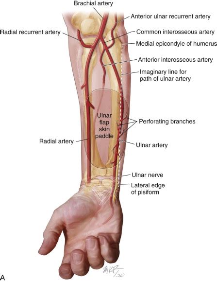 Radial Forearm Flap | Pocket Dentistry