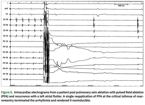 The Promise of Pulsed Field Ablation: An Update