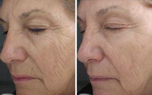 Jan Marini Skin Care | Before & After | LightRx MedSpa