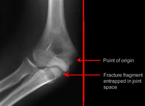 Medial Epicondyle Humerus