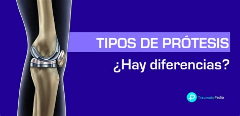 Tipos de prótesis de rodilla -¿Cuál es mejor? - Traumatopedia