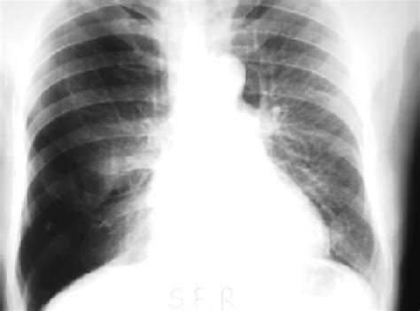 Pathophysiology of reexpansion pulmonary edema | Download Scientific ...