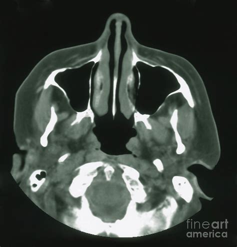 Normal Mri Of Sinuses Photograph by Science Source