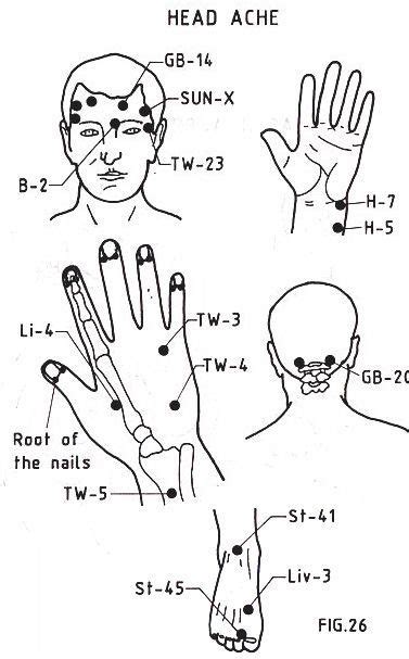 How to Stop Migraines with Acupuncture and TCM – Makari Wellness