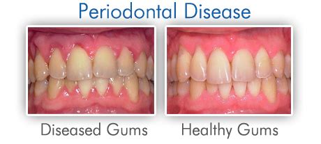 Periodontal / Gum Disease - Midway Dental Center