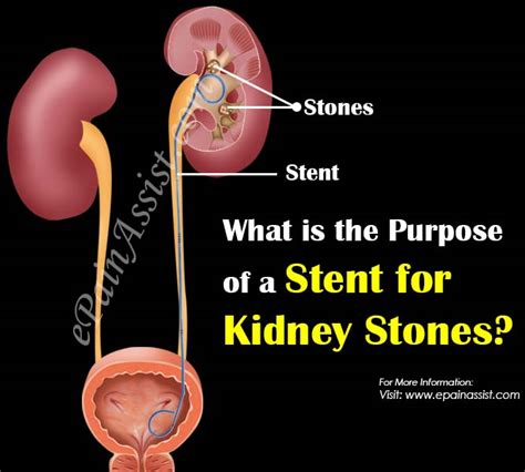 How Does A Stent Work For Kidney Stones - HealthyKidneyClub.com