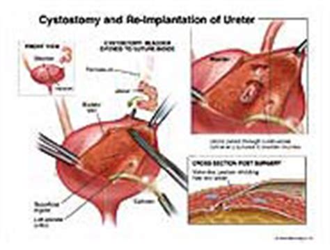 Cystostomy and Re-Implantation of Ureter Medical Exhibit