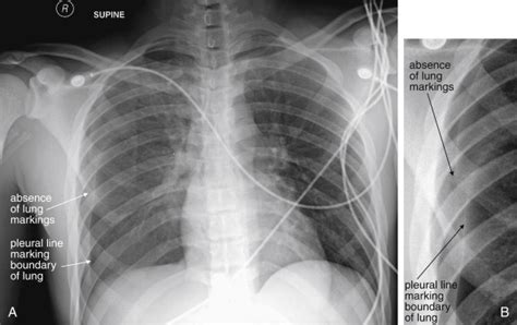 Imaging Chest Trauma | Radiology Key