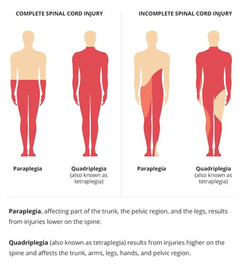 Quadriplegia Tetraplegia Definition Causes Symptoms