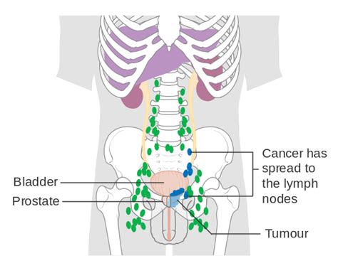 File:Diagram showing prostate cancer that has spread to the lymph nodes ...