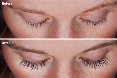 Latisse Eyelash Enhancement in Minneapolis - Zel Skin