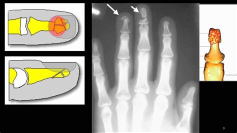 tuft fracture - fracture of the distal finger tip - YouTube