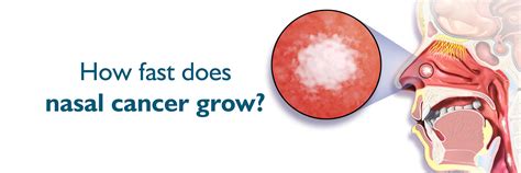 How Fast Does Nasal Cancer Grow? Understanding Nasal Cancer