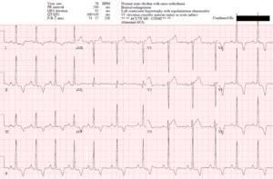 Reciprocal Changes and Occlusion MI | ECG Cases | Emergency Medicine Cases