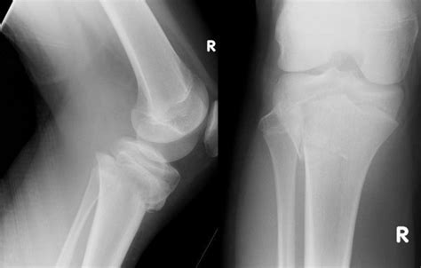 Salter-Harris II injury of the proximal tibial epiphysis with both vascular compromise and ...