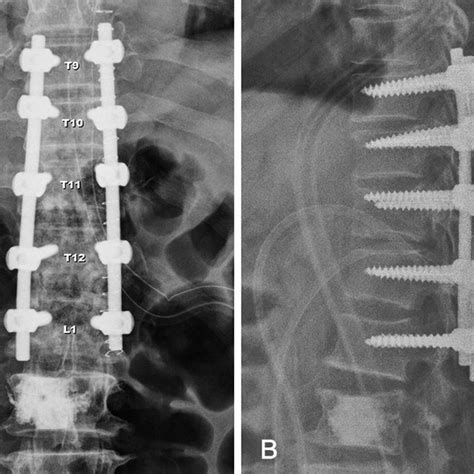 Sagittal T2 MRI of T-spine. Showing increased signal intensity of... | Download Scientific Diagram