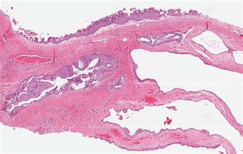 Pathology Outlines - Glandular odontogenic cyst