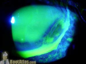 Corneal Thinning - Dellen Stain (Photo) - TimRoot.com