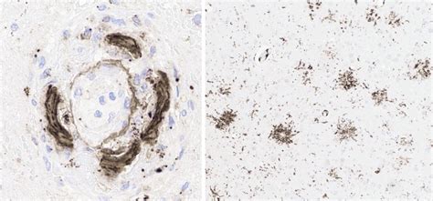 Case Study Reveals Potentially Lethal Side Effects of Lecanemab for Treatment of Alzheimer's ...