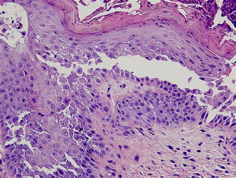 Familial benign chronic pemphigus (Hailey-Hailey disease)