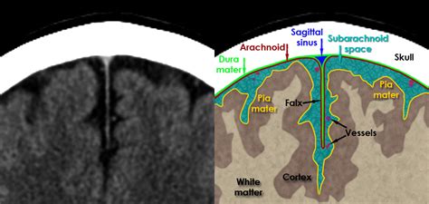CT Brain Anatomy - Meninges