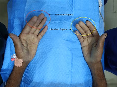 Cureus | Raynaud's Phenomenon During Non-operating Room Anesthesia: A ...