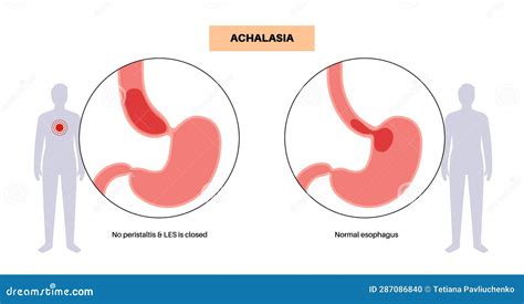 Esophageal Achalasia Disease Stock Illustration - Illustration of ...