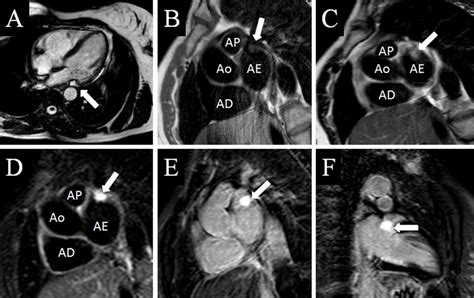 MRI images showing the pedunculated mass (white arrows) located in the... | Download Scientific ...