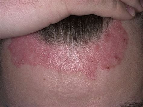 Psoriasis | McLean & Woodbridge VA