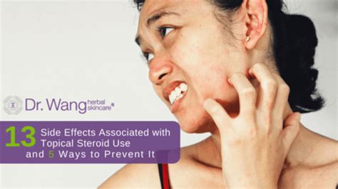 13 Side Effects Associated With Topical Steroid Use + 5 Ways to Prevent it – Dr. Wang Herbal ...