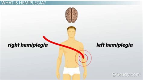 What Is Hemiplegia? - Definition, Symptoms & Treatment - Lesson | Study.com