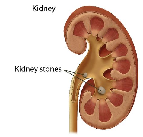 Kidney Stones Symptoms, Risk Factors, and Diagnosis | Saint John’s Cancer Institute - Santa ...