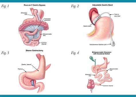 Laparoscopic Surgery for Morbid Obesity Patient Information from SAGES