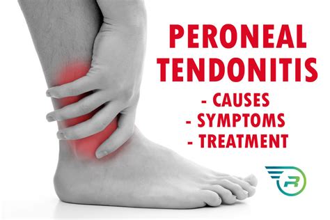 Build A Tips About How To Treat Peroneal Tendonitis - Makepanic42