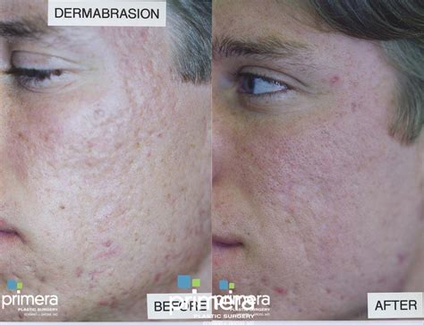 Dermabrasion for Orlando & Winter Park, FL | Primera Plastic Surgery