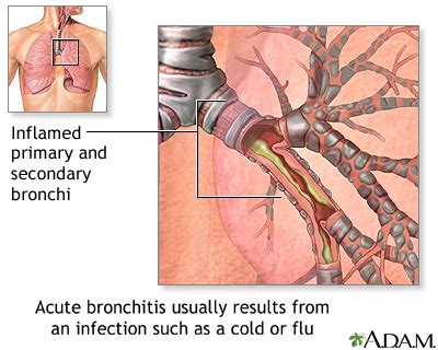 Bronchitis - acute Information | Mount Sinai - New York