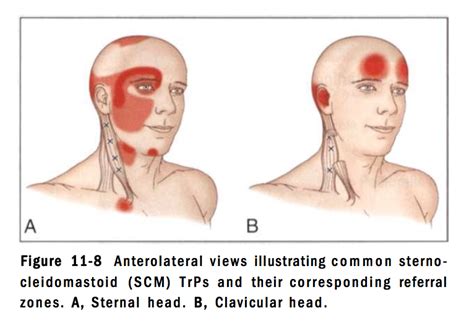 Sternocleidomastoid Muscle Stretch