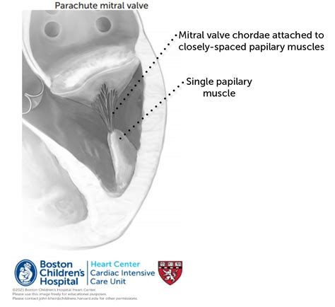 Mitral Valve Pathologies – Online supplement