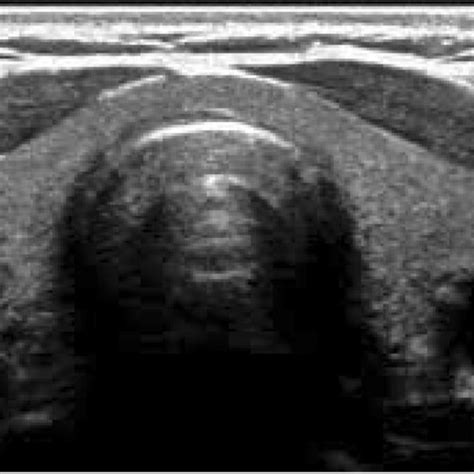 Gray-scale ultrasound images show heterogeneous thyroid parenchyma in a... | Download Scientific ...