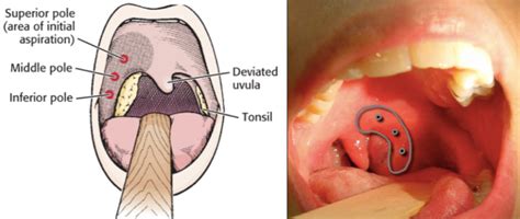 All you need to know about peritonsillar abscess — Covington Smiles