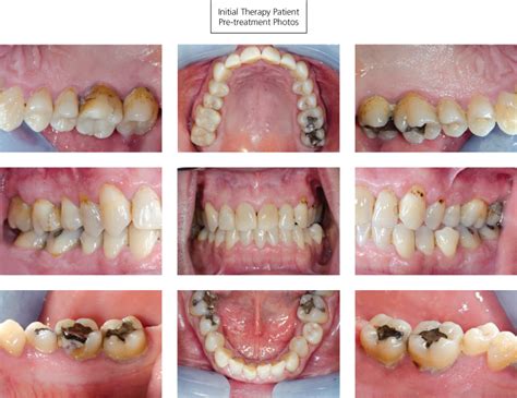 8: Case studies in ultrasonic debridement | Pocket Dentistry